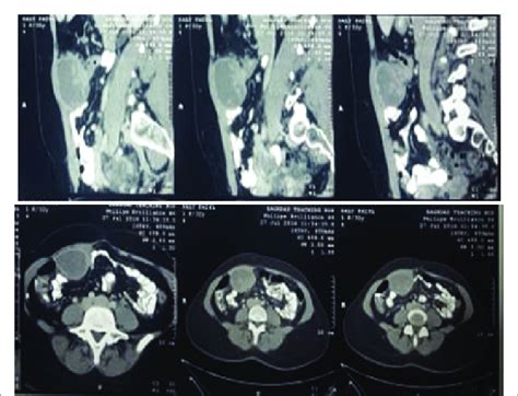 does endometriosis show up on ct scan